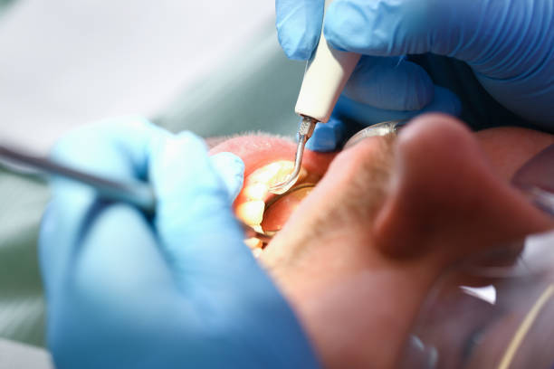 Best Emergency Tooth Extraction  in Mpbell, CA